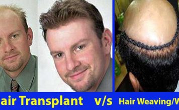 Hair Weaving Vs. Hair Transplant Which One Is Better