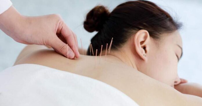 A Brief Yet Fascinating History of Acupuncture
