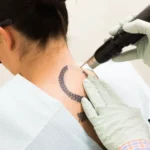 Specialist for Your Tattoo Removal