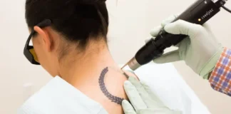 Specialist for Your Tattoo Removal