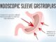 Endoscopic Sleeve Gastroplasty
